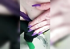 Very swollen caged ball's day two